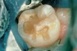 Figure 5  Tooth preparation for resin-modified glass-ionomer repair.