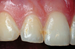 Figure 8  Mesio-labial lesion of a permanent lateral incisor.