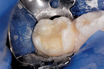 Figure 11  Molar prepared and dentin replaced with Vitrebond liner.