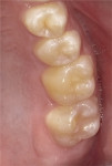 Occlusal photographs (EyeSpecial, Shofu) of anesthesia-free posterior restorations that were completed with a bioactive flowable hybrid composite that releases and recharges fluoride.