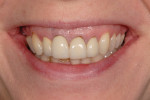 The pretreatment smile photograph demonstrating uneven gingival margins, visible crown margins, vertical maxillary excess, and narrow buccal corridors.