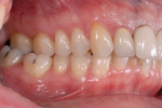 Pretreatment retracted and right and left lateral photographs showing bilateral posterior crossbites, a Class II occlusal relationship, and gingival asymmetry.