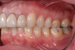 Pretreatment retracted and right and left lateral photographs showing bilateral posterior crossbites, a Class II occlusal relationship, and gingival asymmetry.