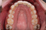 The pretreatment maxillary and mandibular occlusal photographs revealed a narrow upper arch and a crowded lower arch.
