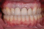 Post-orthodontic/orthognathic treatment retracted and right and left lateral photographs displaying the successful surgical correction of the posterior crossbites, the correction from Class II to Class I with the mandibular advancement, and the orthodontic alignment of the maxillary gingival margins. Note: the porcelain on the restorations required adjustment as the gingival margins were aligned.