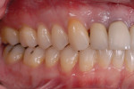 Post-orthodontic/orthognathic treatment retracted and right and left lateral photographs displaying the successful surgical correction of the posterior crossbites, the correction from Class II to Class I with the mandibular advancement, and the orthodontic alignment of the maxillary gingival margins. Note: the porcelain on the restorations required adjustment as the gingival margins were aligned.