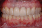 The existing restorations were removed, and the preparations were refined. After final impressions were taken with silicone, provisional restorations were fabricated and cemented with temporary cement.