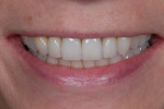 Posttreatment smile photograph taken after delivery of the definitive lithium disilicate restorations. Note that the smile better filled the buccal corridors and less gingival display was present upon smiling.