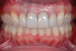 Posttreatment retracted, close-up, and maxillary/mandibular occlusal photographs demonstrating the improved occlusal scheme, including wider arches, mandibular advancement from Class II to Class I, and improved gingival architecture.