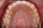 Posttreatment retracted, close-up, and maxillary/mandibular occlusal photographs demonstrating the improved occlusal scheme, including wider arches, mandibular advancement from Class II to Class I, and improved gingival architecture.