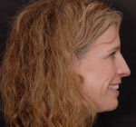 Posttreatment full-face and profile photographs showing a less gummy and wider smile. Note how the chin has come forward with the mandibular advancement, elongating the neck and bringing the lips closer to one another at rest.