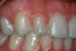 Bonded resin “angel wing retainers” maintaining the position of the patient’s diminutive maxillary lateral incisors.