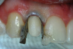 Close-up labial view of the bur-roughened tooth with retraction cord in place and custom-contoured stainless steel matrix strips bonded to the adjacent teeth.