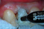 The first increment of resin-based composite was injected onto the labial surface.