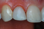 Immediate postoperative close-up view of the restored maxillary right lateral incisor.