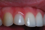 Close-up photograph of the maxillary right lateral incisor taken 1-year postoperatively.