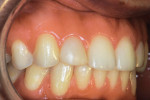 Retracted lateral and close-up lingual photographs of the maxillary right lateral incisor taken 4-years postoperatively.
