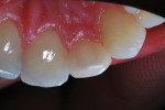 Retracted lateral and close-up lingual
photographs of the maxillary right lateral incisor taken 4-years postoperatively.