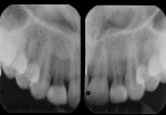 Periapical radiographs of both maxillary lateral incisors acquired 4-years postoperatively.