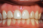 Retracted photograph of the resin-based composite maxillary lateral crowns taken 5-years, 7-months postoperatively.