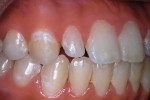 Pretreatment photograph of diminutive maxillary right lateral incisor in a 15-year-old female patient who had completed orthodontic treatment.