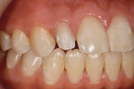 Conservative enamel reduction for veneer placement was performed with a water-cooled diamond bur.