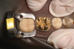 Figure 3  A retainer on the tooth shows four-point contact.