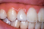 Close-up photograph of the lithium disilicate veneer taken 20 months after placement.