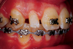 Pretreatment right and left lateral retracted photographs of a 13-year-old female patient with diminutive maxillary lateral incisors after completion of orthodontic treatment.