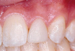 Left lateral close-up view of the patient’s maxillary left lateral incisor taken 6 years after coronal augmentation with resin-based composite.