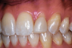 Right and left lateral retracted views of the patient’s coronally augmented maxillary lateral incisors taken 26-years postoperatively.