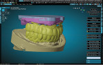 Fig 1. Intraoral scans are aligned with the scans of the verified master casts, displayed in the CAD software.