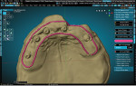 Fig 5. The tissue base of the final restoration is created and displayed in the Digi Flipper Module with an outline created to help control the placement of the tissue replication.