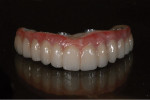 Fig 16. The final 3Y zirconia restoration after polishing and staining.
