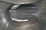 Figure 9: Anterior view of a patient with a rubber dam placed on the maxillary and mandibular arches using a Woodbury frame.