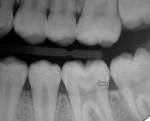 Fig 1. Preoperative bitewing radiograph obtained in December 2016. The caries on tooth No. 19 extended into the apical third of the dentin (arrow). Pulp vitality testing consisted of percussion, palpation, sensibility testing, and periodontal probing. All test results were within normal limits.