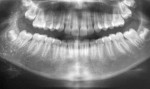 Fig 2. Preoperative panoramic radiograph obtained in December 2016.