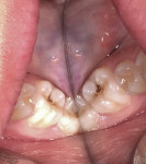 Fig 3. Preoperative clinical photograph that indicated no inflammation or sinus tract in the area on tooth No. 19.