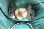 Fig 4. Tooth No. 19 after partial caries removal.