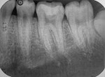 Fig 8. Final assessment post-treatment periapical radiograph (December 2020) indicated no periapical radiolucency on tooth No. 19. Pulp vitality testing indicated that the pulp was vital.
