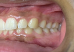 Fig 9. Final assessment post-treatment clinical buccal view photograph (December 2020) indicated no inflammation or sinus tract.