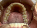 Fig 10. Final assessment post-treatment clinical occlusal view photograph (December 2020) showed no indication for dental concern.