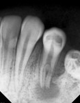 Fig 1. Initial periapical radiograph showed an atypical anatomy of the mandibular left first premolar.