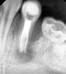 Fig 5. Periapical radiograph immediately after endodontic treatment.