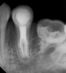 Fig 7. Periapical radiograph at 1-year follow-up showed regression of periapical lesion.