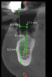 Fig 1. CBCT of mandibular jaw showed 6 mm to 8 mm of bone height coronal to the IAN but a 5 mm to 7 mm buccolingual discrepancy between the mandibular ridge and the opposite dentition.