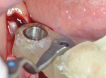 Fig 3. Surgical guide was positioned on the remaining mandibular teeth.