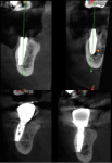 Fig 5. Two months after implant placement, implant integration was noted (top two images). Two years postoperative, preservation of the buccal plate of bone was evident in spite of its minimal thickness (bottom two images).