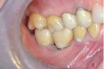 Fig 6 and Fig 7. In pretreatment photograph (Fig 6), note severe buccolingual discrepancy with the opposite dentition. In post-treatment photograph (Fig 7), note that two CAD/CAM zirconia splinted crowns were fabricated in proper occlusion and cemented on the implants.