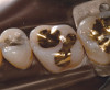 Figure 15  Maxillary prosthesis framework try-in. Metal occlusal surfaces on the left molar.